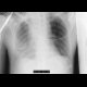 Malposition of central venous line, infusion in mediastinum: X-ray - Plain radiograph